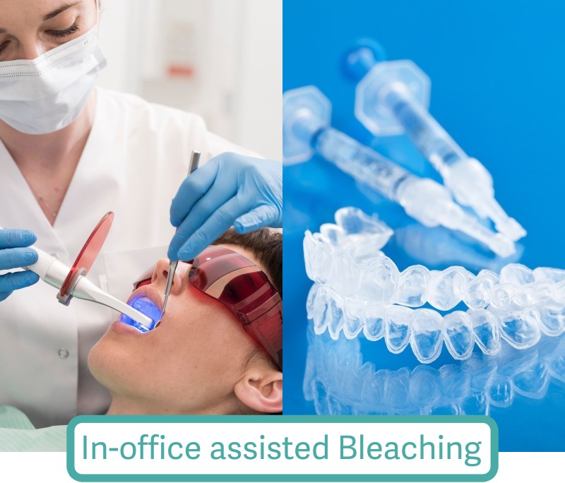 At-home Bleaching