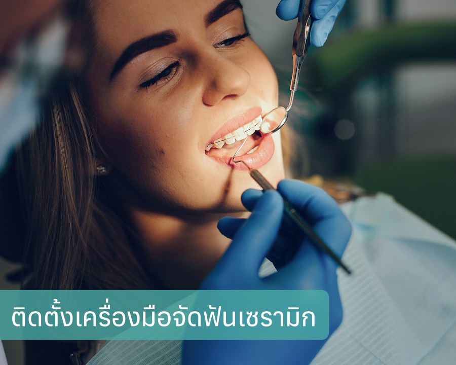 ติดตั้งเครื่องมือจัดฟันเซรามิก
