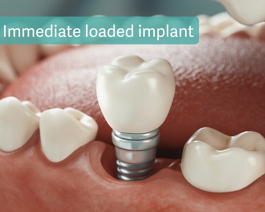 Immediate loaded implant