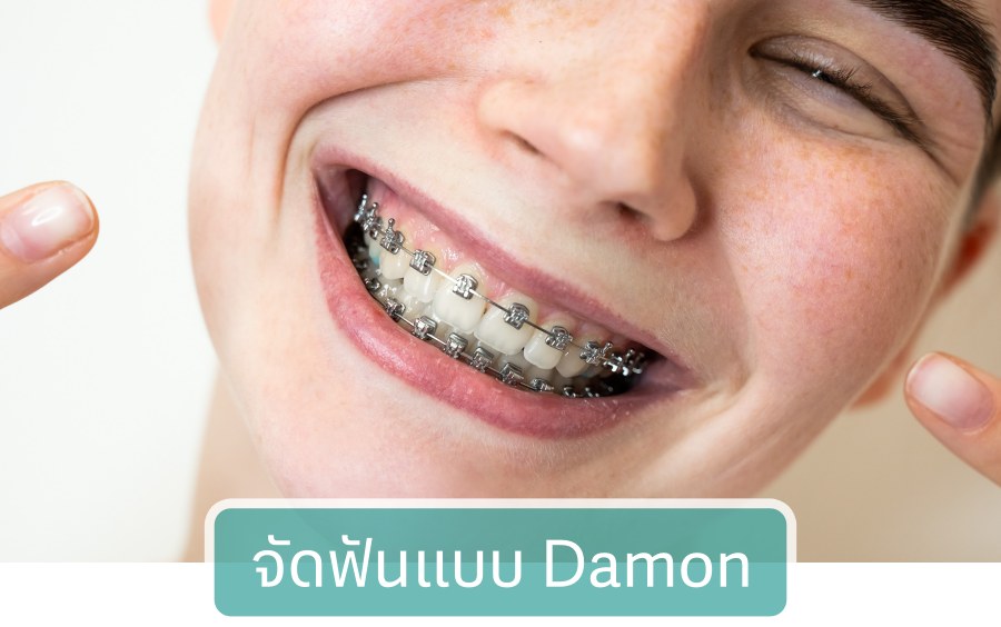 จัดฟันแบบ Damon