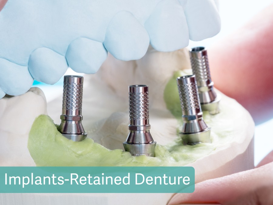 Implants-Retained Denture
