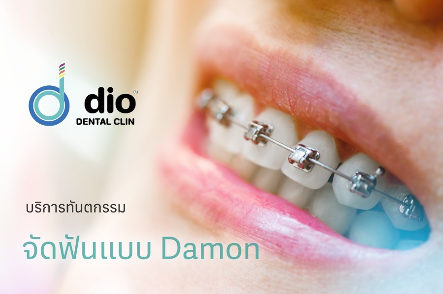 จัดฟันแบบ Damon