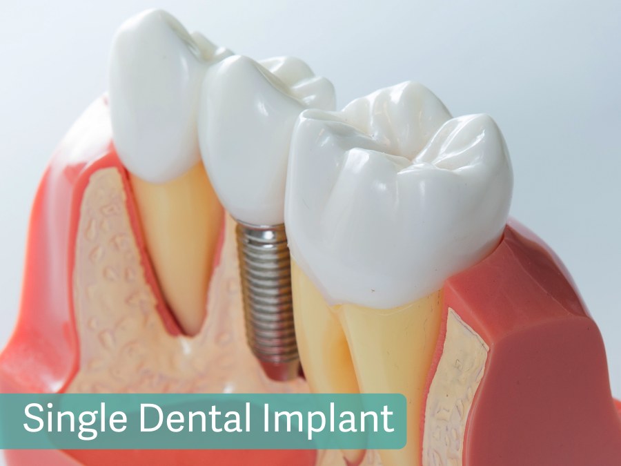 Single Dental Implant