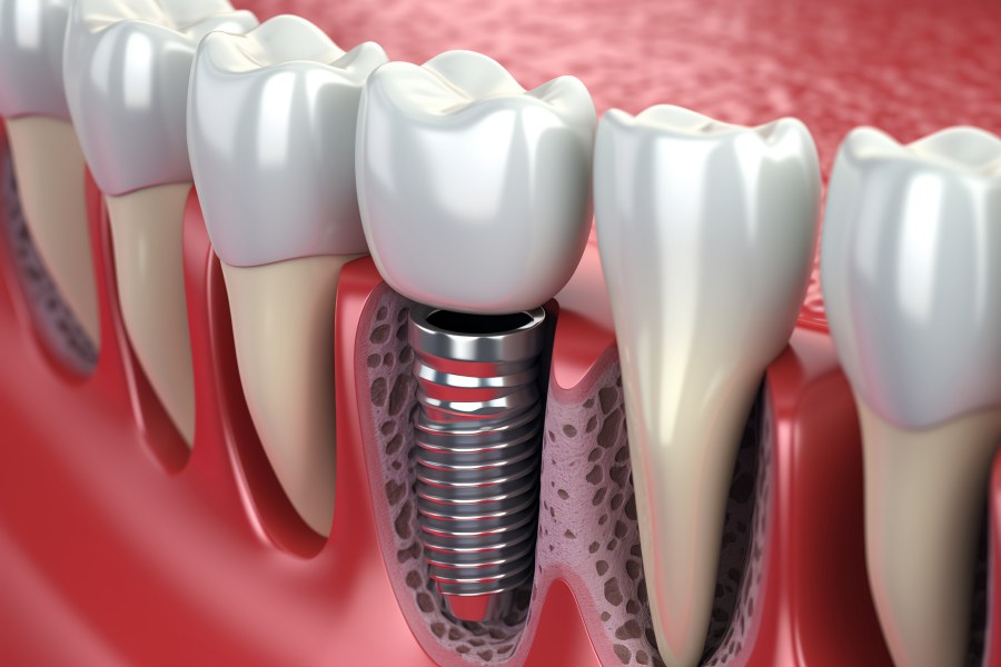 รากฟันเทียม The function of dental implants