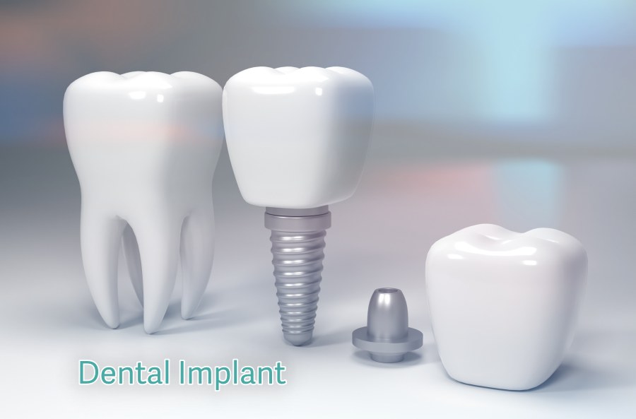 Dental Implant