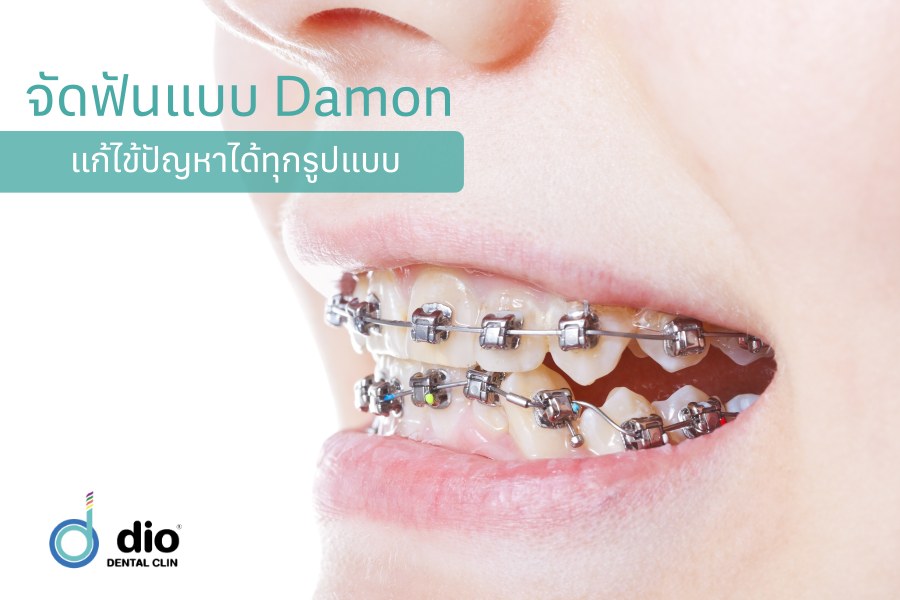 จัดฟันแบบ Damon แก้ไข้ปัญหาได้ทุกรูปแบบ