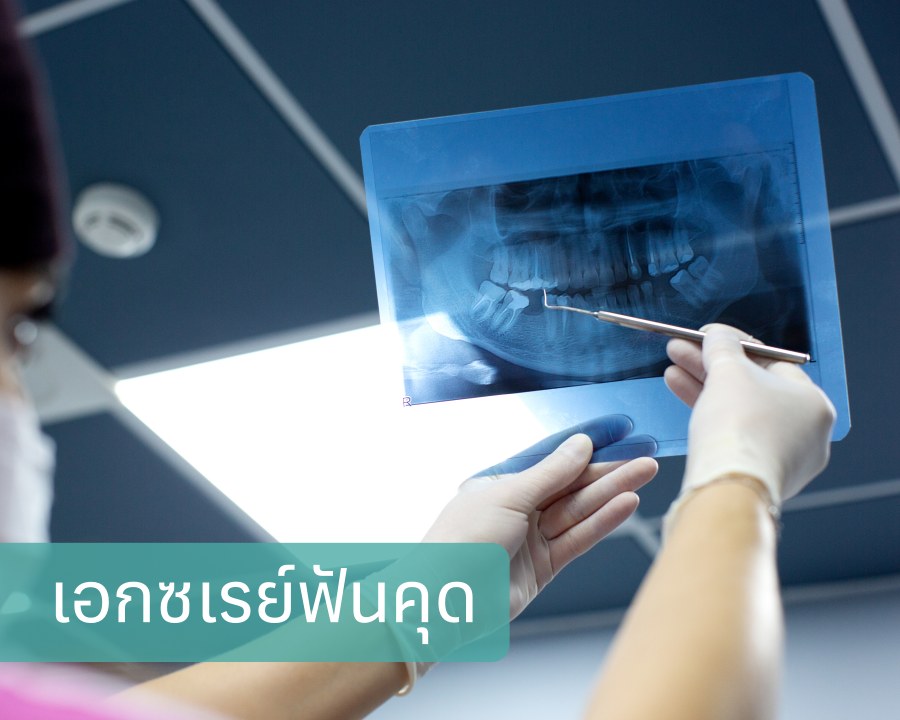 เอกซเรย์ฟันคุด