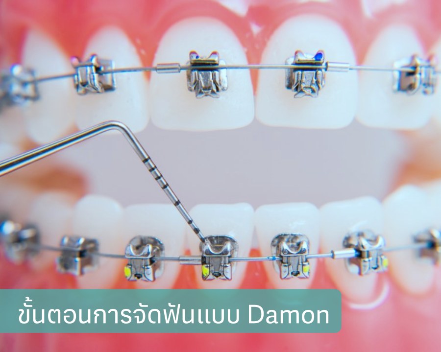 ขั้นตอนการจัดฟันแบบ Damon