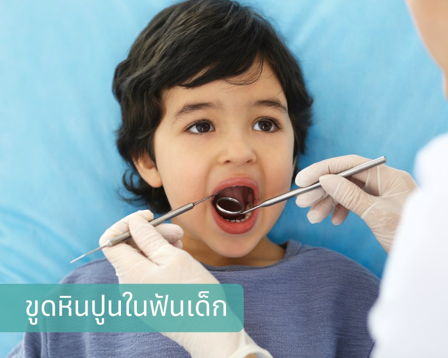 ขูดหินปูนในฟันเด็ก