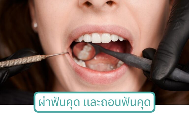 ผ่าฟันคุด ถอนฟันคุด