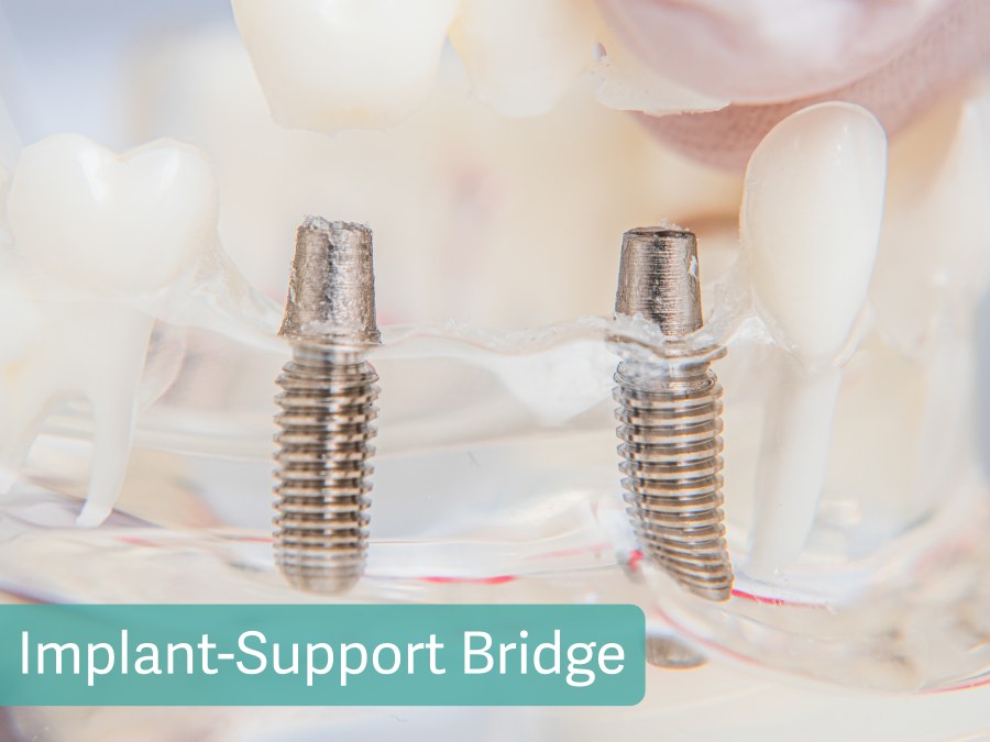 Implant-Support Bridge
