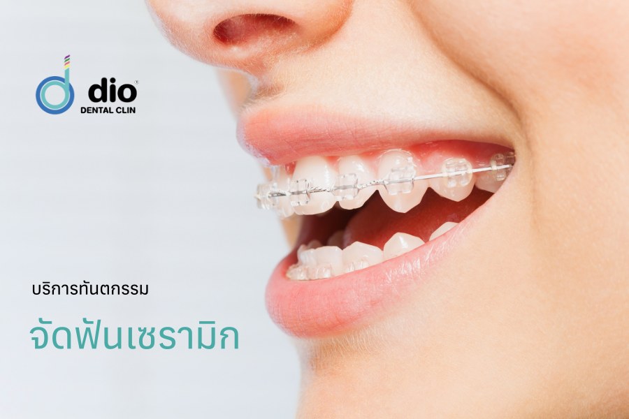จัดฟันเซรามิก