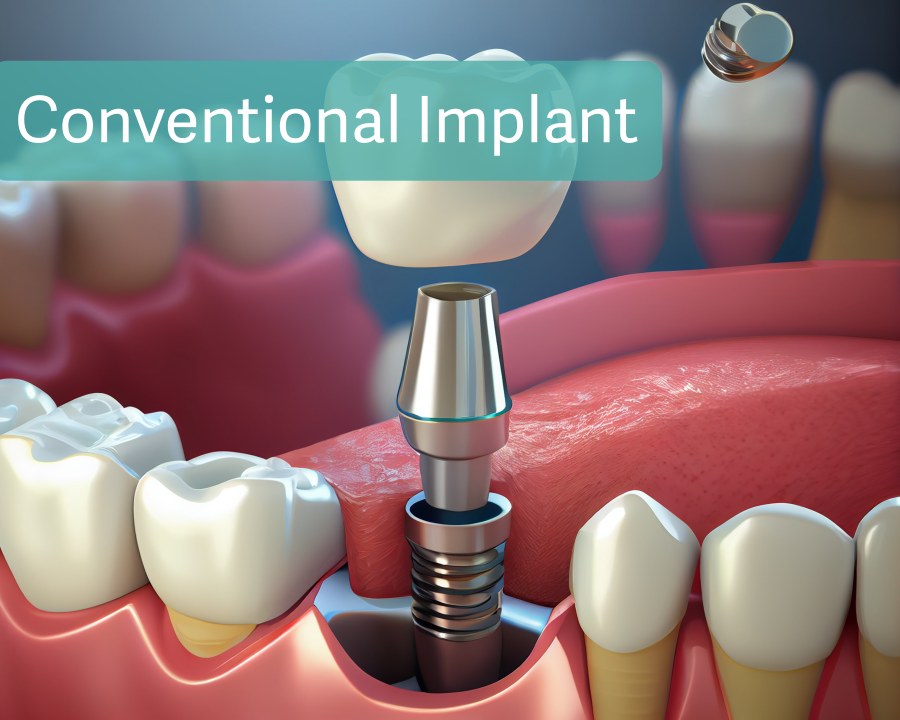 Conventional Implant