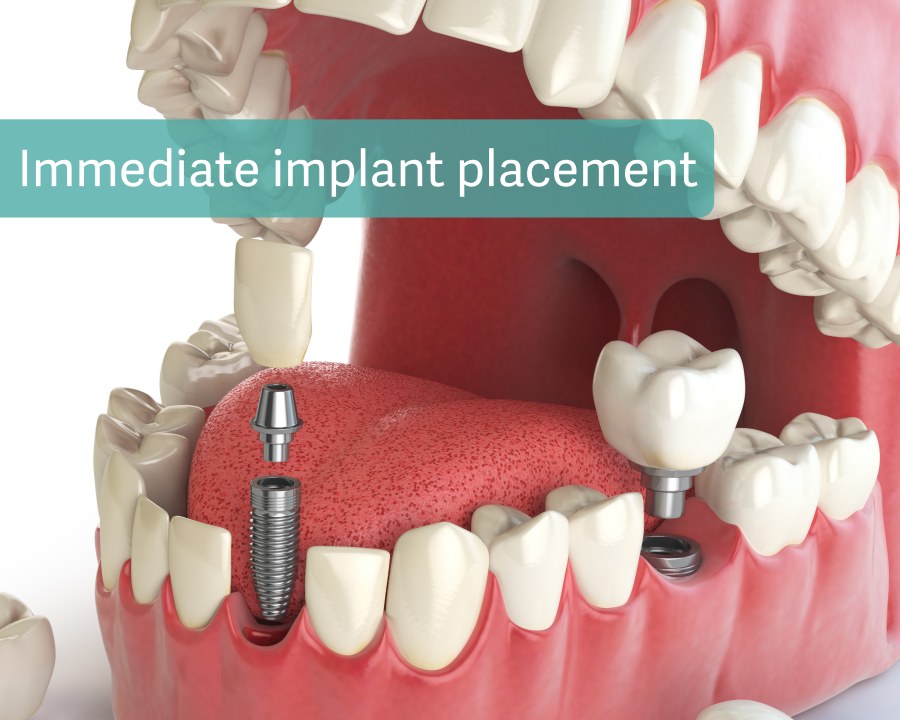 Immediate implant placement 