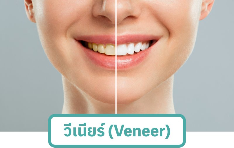 วีเนียร์ (Veneer)