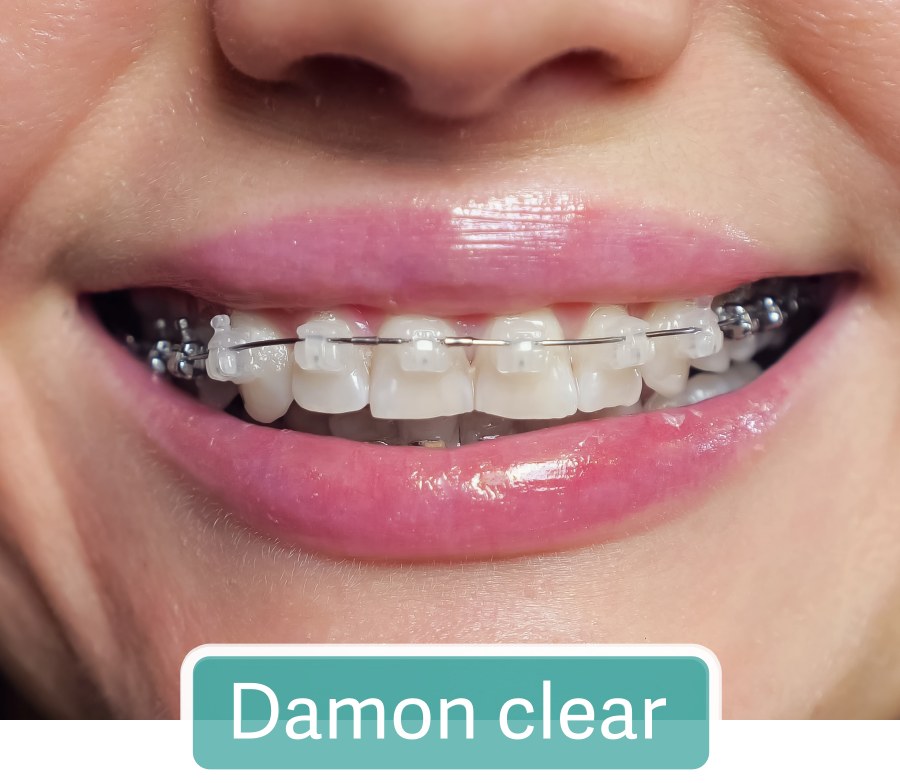 Damon clear