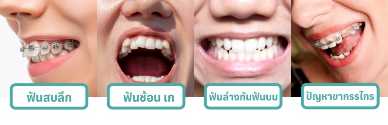 ปัญหาฟันที่ต้องจัดฟัน