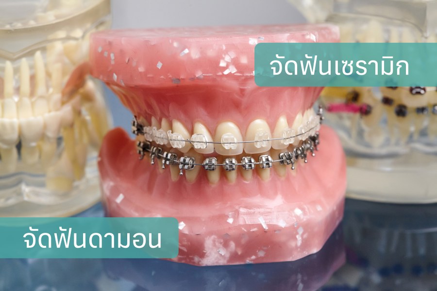 ความแตกต่างระหว่างการจัดฟันแบบเซรามิก และแบบโลหะดังเดิม