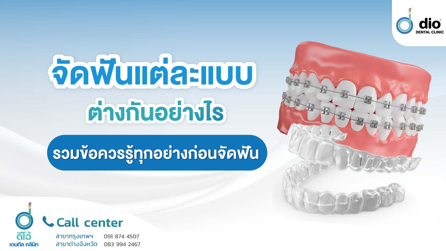 จัดฟัน