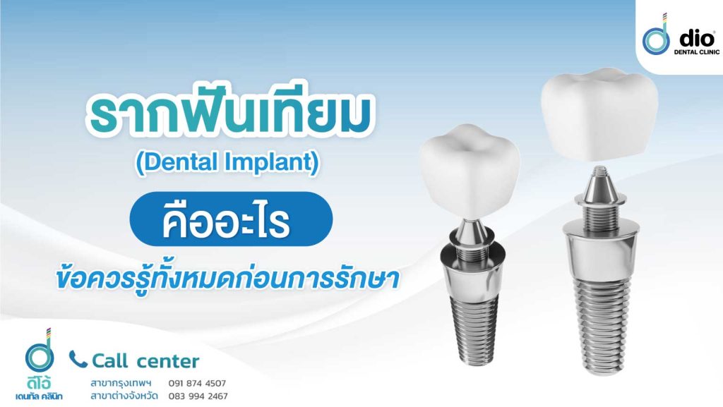 รากฟันเทียม